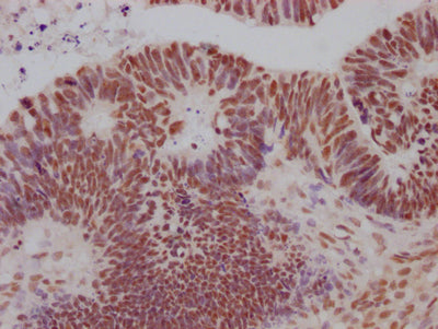 IHC image of SIN3A Recombinant Monoclonal Antibody diluted at 1:100 and staining in paraffin-embedded human ovarian cancer performed on a Leica BondTM system. After dewaxing and hydration, antigen retrieval was mediated by high pressure in a citrate buffer (pH 6.0). Section was blocked with 10% normal goat serum 30min at RT. Then primary antibody (1% BSA) was incubated at 4℃ overnight. The primary is detected by a Goat anti-rabbit IgG polymer labeled by HRP and visualized using 0.05% DAB.