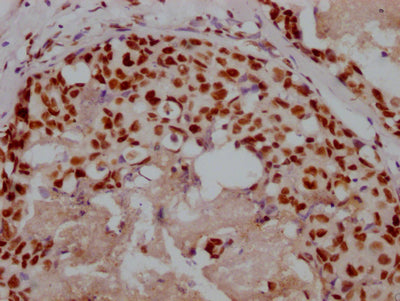 IHC image of XRCC5 Recombinant Monoclonal Antibody diluted at 1:100 and staining in paraffin-embedded human breast cancer performed on a Leica BondTM system. After dewaxing and hydration, antigen retrieval was mediated by high pressure in a citrate buffer (pH 6.0). Section was blocked with 10% normal goat serum 30min at RT. Then primary antibody (1% BSA) was incubated at 4℃ overnight. The primary is detected by a Goat anti-rabbit IgG polymer labeled by HRP and visualized using 0.05% DAB.