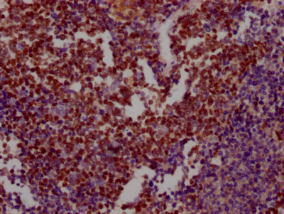 IHC image of XRCC5 Recombinant Monoclonal Antibody diluted at 1:100 and staining in paraffin-embedded human lung cancer performed on a Leica BondTM system. After dewaxing and hydration, antigen retrieval was mediated by high pressure in a citrate buffer (pH 6.0). Section was blocked with 10% normal goat serum 30min at RT. Then primary antibody (1% BSA) was incubated at 4℃ overnight. The primary is detected by a Goat anti-rabbit IgG polymer labeled by HRP and visualized using 0.05% DAB.