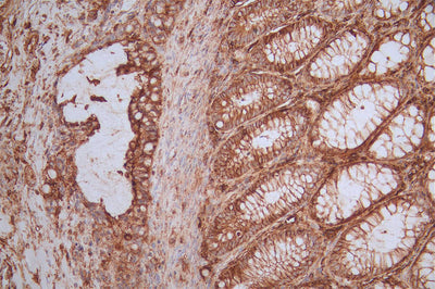 IHC image of CD44 Recombinant Monoclonal Antibody diluted at 1:50 and staining in paraffin-embedded human rectal cancer performed on a Leica BondTM system. After dewaxing and hydration, antigen retrieval was mediated by high pressure in a citrate buffer (pH 6.0). Section was blocked with 10% normal goat serum 30min at RT. Then primary antibody (1% BSA) was incubated at 4°C overnight. The primary is detected by a Goat anti-rabbit polymer IgG labeled by HRP and visualized using 0.51% DAB.