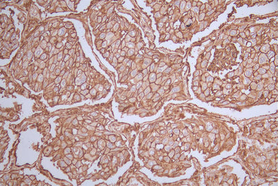 IHC image of CD44 Recombinant Monoclonal Antibody diluted at 1:50 and staining in paraffin-embedded human lung cancer performed on a Leica BondTM system. After dewaxing and hydration, antigen retrieval was mediated by high pressure in a citrate buffer (pH 6.0). Section was blocked with 10% normal goat serum 30min at RT. Then primary antibody (1% BSA) was incubated at 4°C overnight. The primary is detected by a Goat anti-rabbit polymer IgG labeled by HRP and visualized using 0.51% DAB.