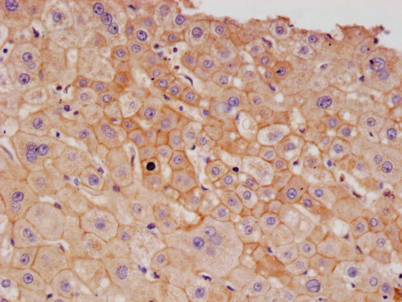 IHC image of ALCAM Recombinant Monoclonal Antibody diluted at 1:100 and staining in paraffin-embedded human liver cancer performed on a Leica BondTM system. After dewaxing and hydration, antigen retrieval was mediated by high pressure in a citrate buffer (pH 6.0). Section was blocked with 10% normal goat serum 30min at RT. Then primary antibody (1% BSA) was incubated at 4°C overnight. The primary is detected by a Goat anti-rabbit polymer IgG labeled by HRP and visualized using 0.05% DAB.