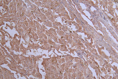 IHC image of the antibody diluted at 1:50 and staining in paraffin-embedded human liver cancer performed on a Leica BondTM system. After dewaxing and hydration, antigen retrieval was mediated by high pressure in a citrate buffer (pH 6.0). Section was blocked with 10% normal goat serum 30min at RT. Then primary antibody (1% BSA) was incubated at 4°C overnight. The primary is detected by a Goat anti-rabbit polymer IgG labeled by HRP and visualized using 0.20% DAB.