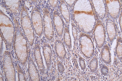 IHC image of SIRPA Recombinant Monoclonal Antibody diluted at 1:50 and staining in paraffin-embedded human rectal cancer performed on a Leica BondTM system. After dewaxing and hydration, antigen retrieval was mediated by high pressure in a citrate buffer (pH 6.0). Section was blocked with 10% normal goat serum 30min at RT. Then primary antibody (1% BSA) was incubated at 4°C overnight. The primary is detected by a Goat anti-rabbit polymer IgG labeled by HRP and visualized using 0.13% DAB.