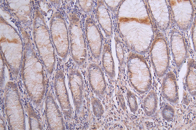 IHC image of SIRPA Recombinant Monoclonal Antibody diluted at 1:50 and staining in paraffin-embedded human rectal cancer performed on a Leica BondTM system. After dewaxing and hydration, antigen retrieval was mediated by high pressure in a citrate buffer (pH 6.0). Section was blocked with 10% normal goat serum 30min at RT. Then primary antibody (1% BSA) was incubated at 4°C overnight. The primary is detected by a Goat anti-rabbit polymer IgG labeled by HRP and visualized using 0.13% DAB.