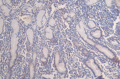 IHC image of the antibody diluted at 1:100 and staining in paraffin-embedded human breast cancer performed on a Leica BondTM system. After dewaxing and hydration, antigen retrieval was mediated by high pressure in a citrate buffer (pH 6.0). Section was blocked with 10% normal goat serum 30min at RT. Then primary antibody (1% BSA) was incubated at 4°C overnight. The primary is detected by a Goat anti-rabbit polymer IgG labeled by HRP and visualized using 0.07% DAB.