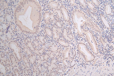 IHC image of Acetyl-HIST1H3A(K18)  Recombinant Monoclonal Antibody diluted at 1:100 and staining in paraffin-embedded human gastric cancer performed on a Leica BondTM system. After dewaxing and hydration, antigen retrieval was mediated by high pressure in a citrate buffer (pH 6.0). Section was blocked with 10% normal goat serum 30min at RT. Then primary antibody (1% BSA) was incubated at 4°C overnight. The primary is detected by a Goat anti-rabbit polymer IgG labeled by HRP and visualized using 0.07% DAB.