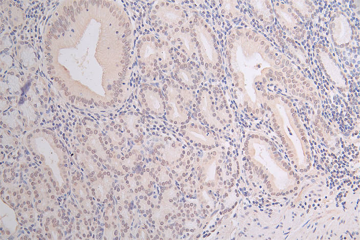 IHC image of Acetyl-HIST1H3A(K18)  Recombinant Monoclonal Antibody diluted at 1:100 and staining in paraffin-embedded human gastric cancer performed on a Leica BondTM system. After dewaxing and hydration, antigen retrieval was mediated by high pressure in a citrate buffer (pH 6.0). Section was blocked with 10% normal goat serum 30min at RT. Then primary antibody (1% BSA) was incubated at 4°C overnight. The primary is detected by a Goat anti-rabbit polymer IgG labeled by HRP and visualized using 0.07% DAB.