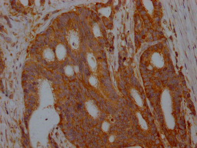 IHC image of ALDOA Recombinant Monoclonal Antibody diluted at 1:100 and staining in paraffin-embedded human colon cancer performed on a Leica BondTM system. After dewaxing and hydration, antigen retrieval was mediated by high pressure in a citrate buffer (pH 6.0). Section was blocked with 10% normal goat serum 30min at RT. Then primary antibody (1% BSA) was incubated at 4℃ overnight. The primary is detected by a Goat anti-rabbit IgG polymer labeled by HRP and visualized using 0.05% DAB.