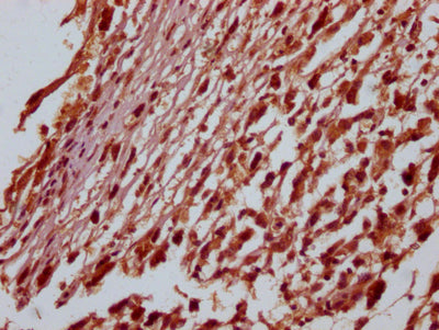 IHC image of SOX10 Recombinant Monoclonal Antibody diluted at 1:100 and staining in paraffin-embedded human melanoma cancer performed on a Leica BondTM system. After dewaxing and hydration, antigen retrieval was mediated by high pressure in a citrate buffer (pH 6.0). Section was blocked with 10% normal goat serum 30min at RT. Then primary antibody (1% BSA) was incubated at 4℃ overnight. The primary is detected by a Goat anti-rabbit IgG polymer labeled by HRP and visualized using 0.05% DAB.