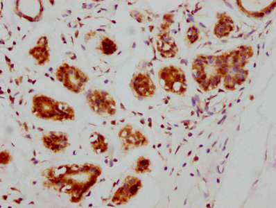 IHC image of ATM Recombinant Monoclonal Antibody diluted at 1:205 and staining in paraffin-embedded human breast cancer performed on a Leica BondTM system. After dewaxing and hydration, antigen retrieval was mediated by high pressure in a citrate buffer (pH 6.0). Section was blocked with 10% normal goat serum 30min at RT. Then primary antibody (1% BSA) was incubated at 4℃ overnight. The primary is detected by a biotinylated secondary antibody and visualized using an HRP conjugated SP system.