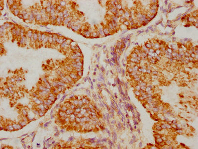 IHC image of BAK1 Recombinant Monoclonal Antibody diluted at 1:90 and staining in paraffin-embedded human endometrial cancer performed on a Leica BondTM system. After dewaxing and hydration, antigen retrieval was mediated by high pressure in a citrate buffer (pH 6.0). Section was blocked with 10% normal goat serum 30min at RT. Then primary antibody (1% BSA) was incubated at 4℃ overnight. The primary is detected by a biotinylated secondary antibody and visualized using an HRP conjugated SP system.