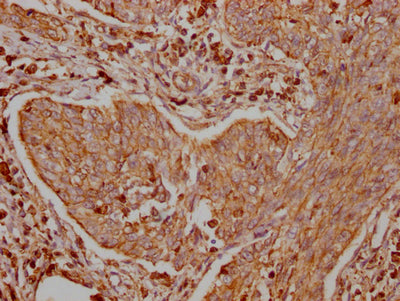 IHC image of TRAF2 Recombinant Monoclonal Antibody diluted at 1:100 and staining in paraffin-embedded human cervical cancer performed on a Leica BondTM system. After dewaxing and hydration, antigen retrieval was mediated by high pressure in a citrate buffer (pH 6.0). Section was blocked with 10% normal goat serum 30min at RT. Then primary antibody (1% BSA) was incubated at 4℃ overnight. The primary is detected by a Goat anti-rabbit IgG polymer labeled by HRP and visualized using 0.05% DAB.