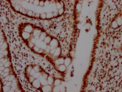 IHC image of TOP1 Recombinant Monoclonal Antibody diluted at 1:100 and staining in paraffin-embedded human colon cancer performed on a Leica BondTM system. After dewaxing and hydration, antigen retrieval was mediated by high pressure in a citrate buffer (pH 6.0). Section was blocked with 10% normal goat serum 30min at RT. Then primary antibody (1% BSA) was incubated at 4℃ overnight. The primary is detected by a Goat anti-rabbit IgG polymer labeled by HRP and visualized using 0.05% DAB.