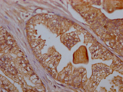 IHC image of CD47 Recombinant Monoclonal Antibody diluted at 1:100 and staining in paraffin-embedded human prostate cancer performed on a Leica BondTM system. After dewaxing and hydration, antigen retrieval was mediated by high pressure in a citrate buffer (pH 6.0). Section was blocked with 10% normal goat serum 30min at RT. Then primary antibody (1% BSA) was incubated at 4℃ overnight. The primary is detected by a Goat anti-rabbit IgG polymer labeled by HRP and visualized using 0.05% DAB.