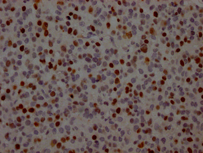 IHC image of TP53 Recombinant Monoclonal Antibody diluted at 1:100 and staining in paraffin-embedded human glioma cancer performed on a Leica BondTM system. After dewaxing and hydration, antigen retrieval was mediated by high pressure in a citrate buffer (pH 6.0). Section was blocked with 10% normal goat serum 30min at RT. Then primary antibody (1% BSA) was incubated at 4℃ overnight. The primary is detected by a Goat anti-rabbit IgG polymer labeled by HRP and visualized using 0.05% DAB.