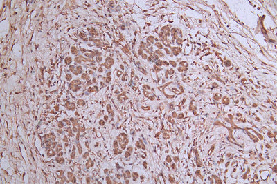 IHC image of TUBB1 Recombinant Monoclonal Antibody diluted at 1:300 and staining in paraffin-embedded human pancreatic cancer performed on a Leica BondTM system. After dewaxing and hydration, antigen retrieval was mediated by high pressure in a citrate buffer (pH 6.0). Section was blocked with 10% normal goat serum 30min at RT. Then primary antibody (1% BSA) was incubated at 4°C overnight. The primary is detected by a Goat anti-Mouse IgG labeled by HRP and visualized using 0.05% DAB.