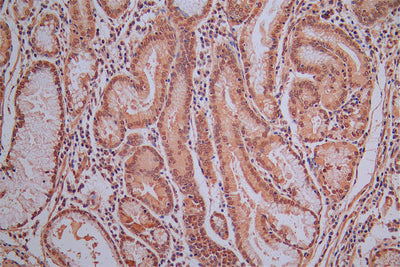 IHC image of ROBO1 Recombinant Monoclonal Antibody diluted at 1:30 and staining in paraffin-embedded human gastric cancer performed on a Leica BondTM system. After dewaxing and hydration, antigen retrieval was mediated by high pressure in a citrate buffer (pH 6.0). Section was blocked with 10% normal goat serum 30min at RT. Then primary antibody (1% BSA) was incubated at 4°C overnight. The primary is detected by a Goat anti-Mouse IgG labeled by HRP and visualized using 0.05% DAB.