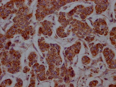 IHC image of SLC16A1 Recombinant Monoclonal Antibody diluted at 1:100 and staining in paraffin-embedded human breast cancer performed on a Leica BondTM system. After dewaxing and hydration, antigen retrieval was mediated by high pressure in a citrate buffer (pH 6.0). Section was blocked with 10% normal goat serum 30min at RT. Then primary antibody (1% BSA) was incubated at 4℃ overnight. The primary is detected by a Goat anti-rabbit IgG polymer labeled by HRP and visualized using 0.05% DAB.