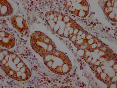 IHC image of SLC16A1 Recombinant Monoclonal Antibody diluted at 1:100 and staining in paraffin-embedded human colon cancer performed on a Leica BondTM system. After dewaxing and hydration, antigen retrieval was mediated by high pressure in a citrate buffer (pH 6.0). Section was blocked with 10% normal goat serum 30min at RT. Then primary antibody (1% BSA) was incubated at 4℃ overnight. The primary is detected by a Goat anti-rabbit IgG polymer labeled by HRP and visualized using 0.05% DAB.