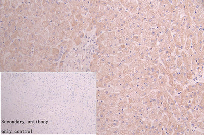 IHC image of ACAA2 Recombinant Monoclonal Antibody diluted at 1:100 and staining in paraffin-embedded human colon cancer performed on a Leica BondTM system. After dewaxing and hydration, antigen retrieval was mediated by high pressure in a citrate buffer (pH 6.0). Section was blocked with 10% normal goat serum 30min at RT. Then primary antibody (1% BSA) was incubated at 4°C overnight. The primary is detected by a Goat anti-rabbit polymer IgG labeled by HRP and visualized using 0.05% DAB.