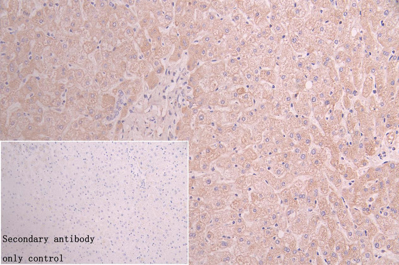 IHC image of ACAA2 Recombinant Monoclonal Antibody diluted at 1:100 and staining in paraffin-embedded human colon cancer performed on a Leica BondTM system. After dewaxing and hydration, antigen retrieval was mediated by high pressure in a citrate buffer (pH 6.0). Section was blocked with 10% normal goat serum 30min at RT. Then primary antibody (1% BSA) was incubated at 4°C overnight. The primary is detected by a Goat anti-rabbit polymer IgG labeled by HRP and visualized using 0.05% DAB.